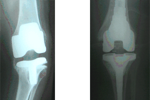 Revision Knee Replacement 1