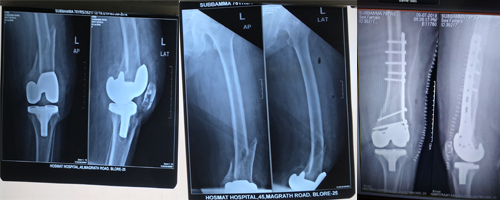 Periprosthetic Fractures 1