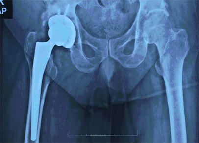 Primary Hip Replacement 1