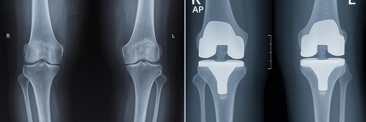 TKR post operative_1